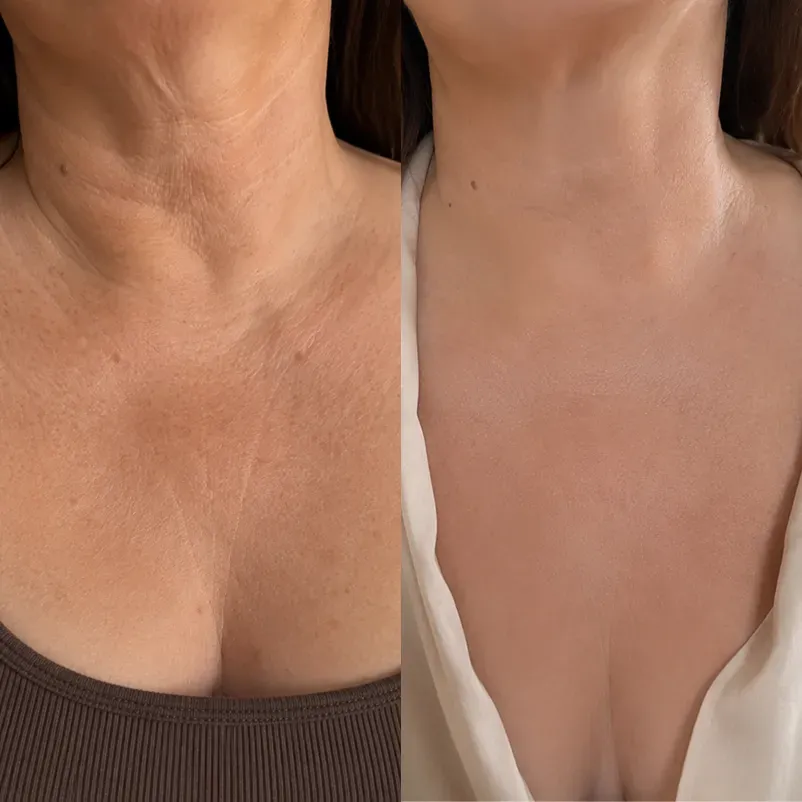 The Korean Needle-Free Botox for Visibly Firmer, Smoother, And More Radiant Skin — Anywhere It Ages