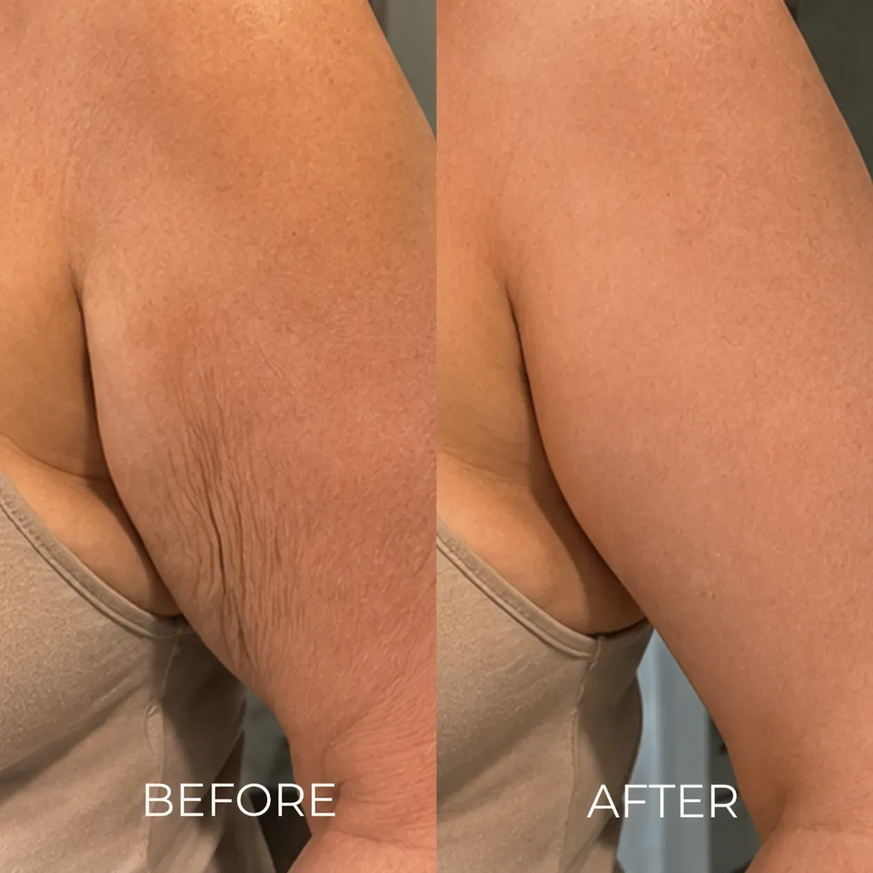 The Korean Needle-Free Botox for Visibly Firmer, Smoother, And More Radiant Skin — Anywhere It Ages