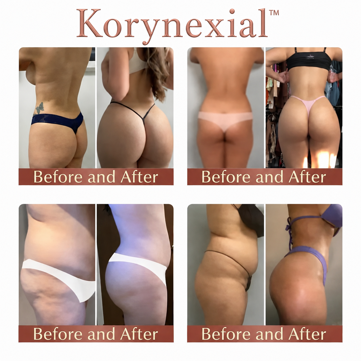 Korynexial™ CurveSculpt Micro-Patch ✦ Sculpt • Firm • Smooth Lower Body Curves ✦ Micro-Needle Infusion System